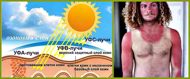 Что такое загар с медицинской точки зрения
